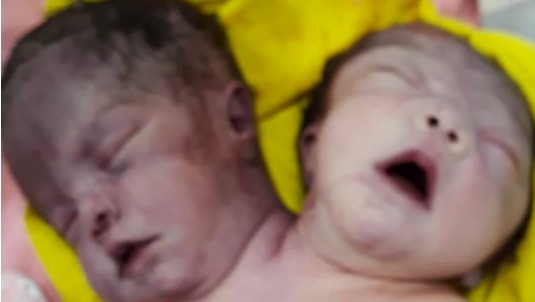 Bebe bicéfalo: Exhumaran el cadáver para realizarle un ADN