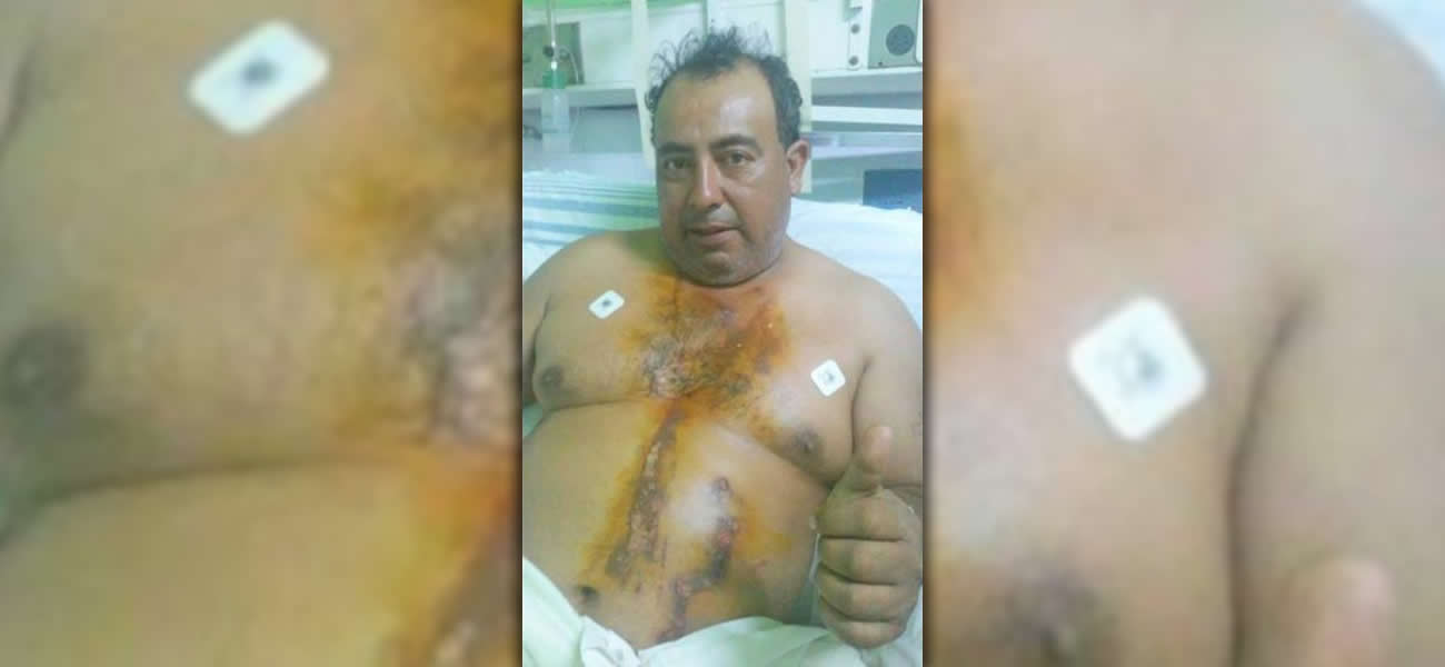 Le cayó un rayo y sobrevivió